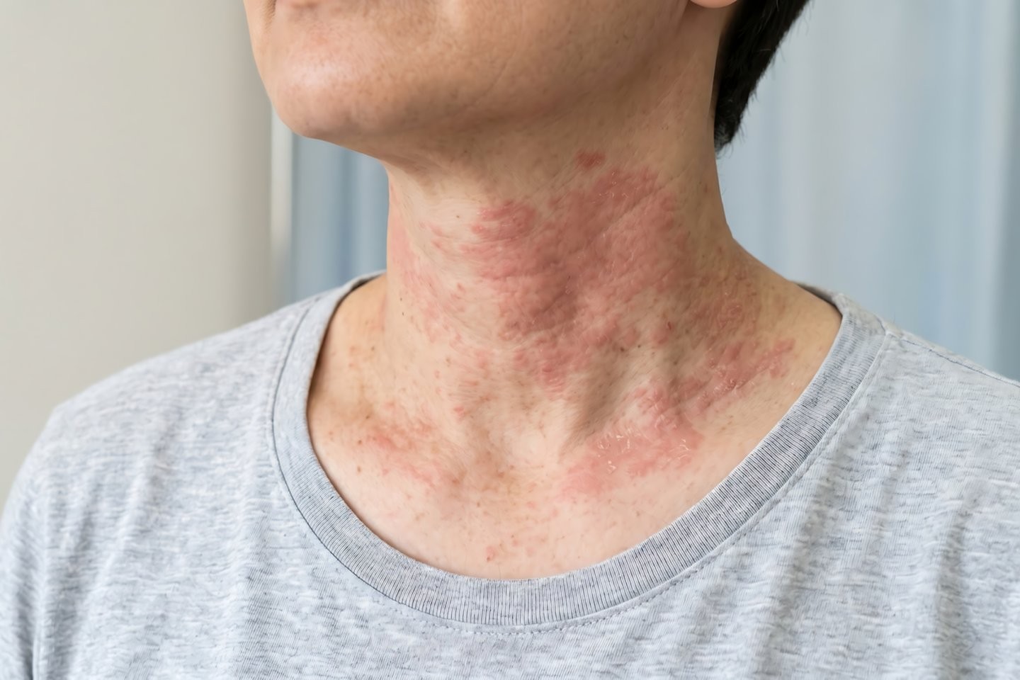 Atopinis dermatitas rudenį: kodėl paūmėja ir kada kreiptis į gydytoją